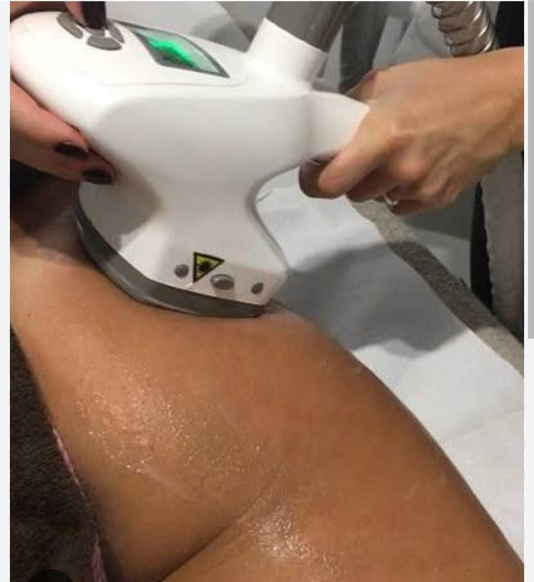 Trattamento HyShape per rimodellamento corpo